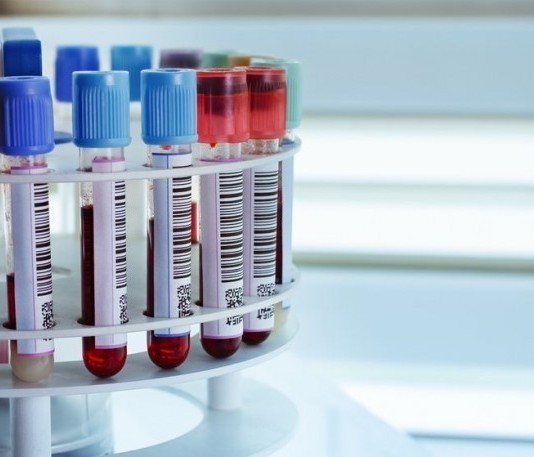 New Blood Test Measures Serum A**hole Levels lab test