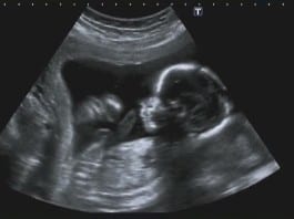 Surgeon Performs In-Utero Tommy John Surgery ultrasound