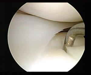 Lateral_meniscus_damaged_tibial_cartilage