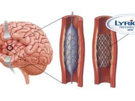 Lyrica-Eluting Stent for End Stage Fibromyalgia Sufferers