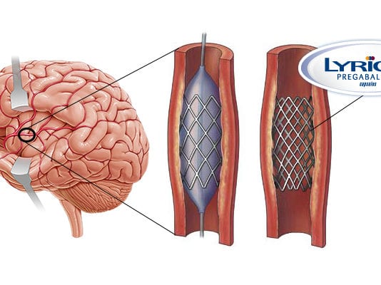 Lyrica-Eluting Stent for End Stage Fibromyalgia Sufferers