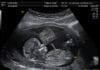 Fetuses Leave Mothers’ Wombs in Pregxit Vote