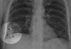 Radiologist Misses Right Lower Lobe Pokémon on Chest X-Ray