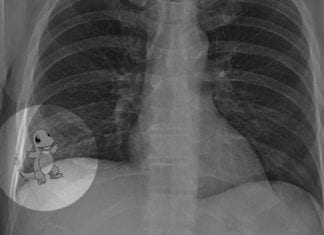 Radiologist Misses Right Lower Lobe Pokémon on Chest X-Ray