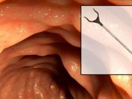 Colonoscopes Replaced by Plastic Reachers from Home Depot plastic grabber