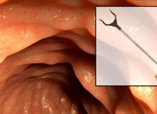 Colonoscopes Replaced by Plastic Reachers from Home Depot plastic grabber