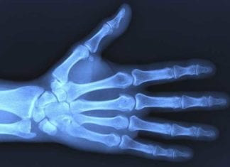 TSA Takes Wrist X-Rays for Poorly-Insured Passenger wrist x-ray