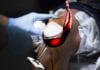 VIP Treatment Offers Merlot, Pinot Noir as Surgical Prep wine for surgical prep