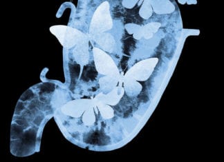 Nervous Patient’s KUB Shows Butterflies in Her Stomach butterflies stomach