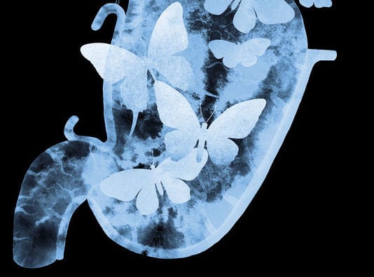 Nervous Patient’s KUB Shows Butterflies in Her Stomach butterflies stomach