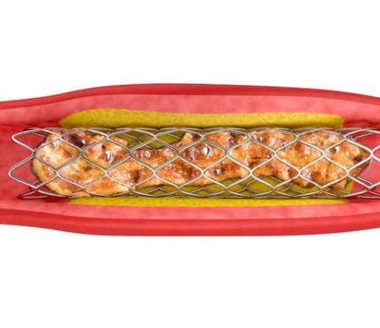 Cardiologists Now Deploying Bacon-Eluting Stents bacon-eluting stent