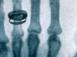 This Day in Medical History: Roentgen Invents Clinical Correlation Roentgen X-ray clinical correlation