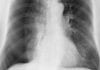 July Intern Really Excited to Cause His Very First Pneumothorax pneumothorax