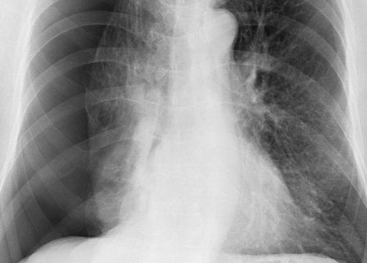 July Intern Really Excited to Cause His Very First Pneumothorax pneumothorax