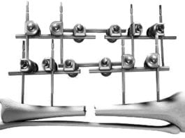 Breaking News: Orthopod Places Ex Fix on Ex Fix ex fixed ex fix