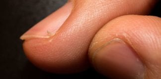 For Hangnails, The American Academy of Dermatology Now Recommends Hand Amputation hangnail hangnails