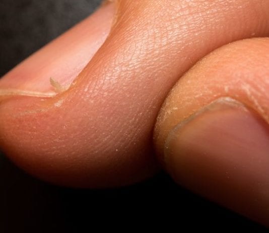 For Hangnails, The American Academy of Dermatology Now Recommends Hand Amputation hangnail hangnails