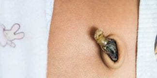 Citing Health Benefits, New Parents Eating Umbilical Cord Stumps umbilical stump