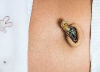 Citing Health Benefits, New Parents Eating Umbilical Cord Stumps umbilical stump