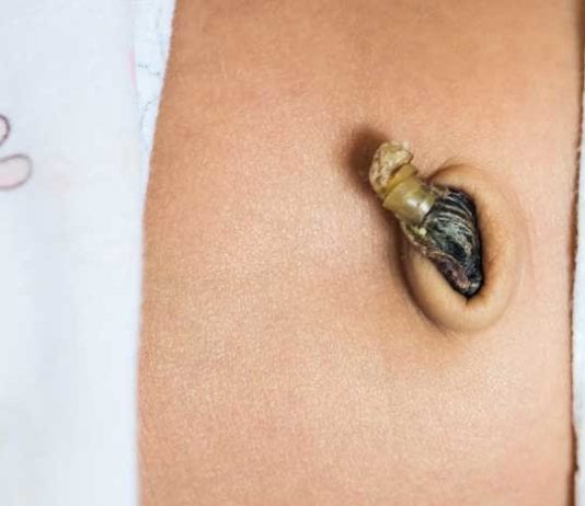 Citing Health Benefits, New Parents Eating Umbilical Cord Stumps umbilical stump