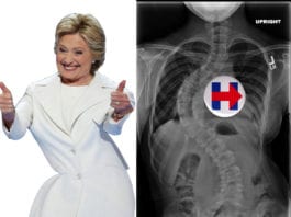 Crooked Hillary Actually Suffering From Severe Scoliosis