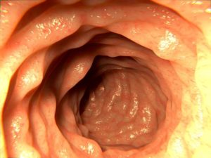 transurethral resection of the colon