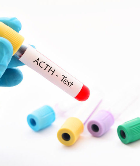 ACTH stim test serum cortisol