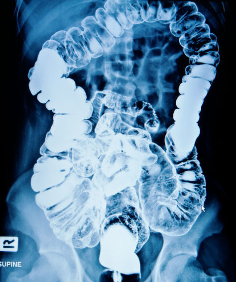 barium enema