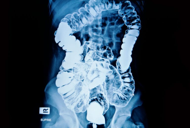 barium enema