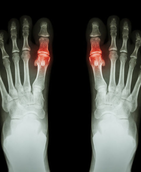 gout