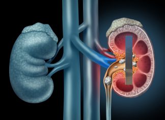 Another Monolith Found Within Patient’s Left Kidney
